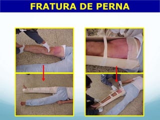 FRATURA DE PERNA
 