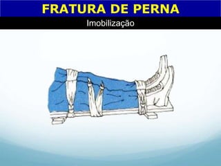 FRATURA DE PERNA
Imobilização
 