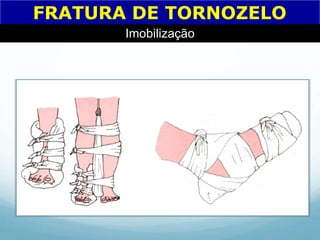 FRATURA DE TORNOZELO
Imobilização
 
