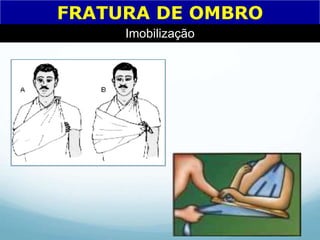 FRATURA DE OMBRO
Imobilização
 