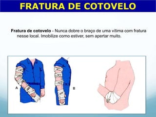 Fratura de cotovelo - Nunca dobre o braço de uma vítima com fratura
nesse local. Imobilize como estiver, sem apertar muito.
FRATURA DE COTOVELO
 