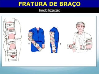 FRATURA DE BRAÇO
Imobilização
 