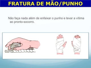 Não faça nada além de enfaixar o punho e levar a vítima
ao pronto-socorro.
FRATURA DE MÃO/PUNHO
 