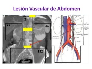 Lesión Vascular de Abdomen
 