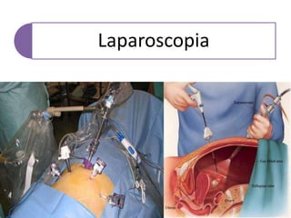 Laparoscopia
 