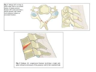 cervical Trauma classification | PPTX
