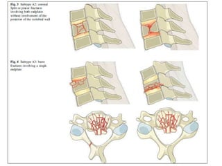 cervical Trauma classification | PPTX