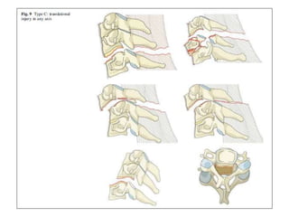 cervical Trauma classification | PPTX