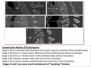 cervical Trauma classification | PPTX