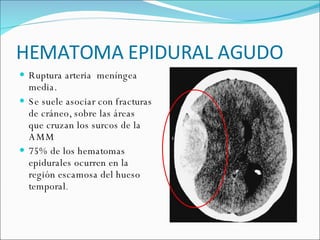 HEMATOMA EPIDURAL AGUDO Ruptura arteria  meníngea media. Se suele asociar con fracturas de cráneo, sobre las áreas  que cruzan los surcos de la AMM  75% de los hematomas epidurales ocurren en la región escamosa del hueso temporal . 