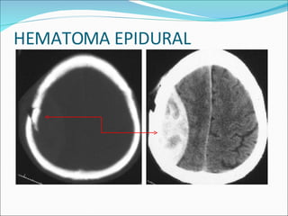 HEMATOMA EPIDURAL 