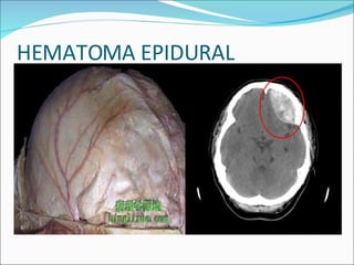 HEMATOMA EPIDURAL 