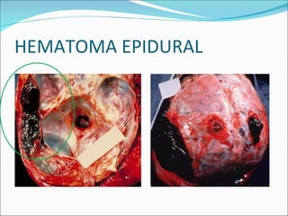 HEMATOMA EPIDURAL 