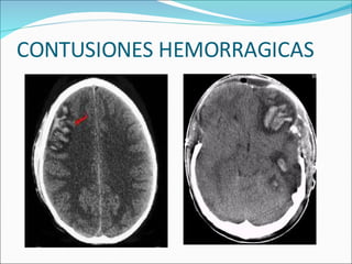CONTUSIONES HEMORRAGICAS 