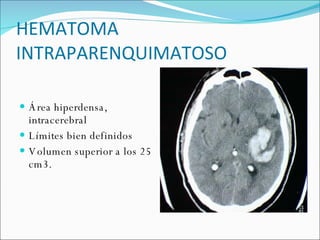 HEMATOMA INTRAPARENQUIMATOSO  Área hiperdensa, intracerebral Límites bien definidos Volumen superior a los 25 cm3. 