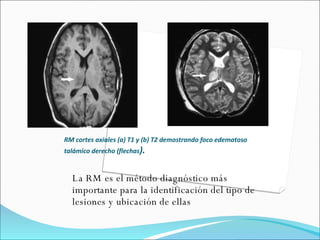 RM cortes axiales (a) T1 y (b) T2 demostrando foco edematoso talámico derecho (flechas ). La RM es el método diagnóstico más importante para la identificación del tipo de lesiones y ubicación de ellas 