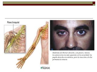 Síndrome de Horner derecho, con ptosis y miosis.
La anisocoria era más aparente en la oscuridad. La
pupila derecha era miótica, pero la reacción a la luz
permanecía intacta
 