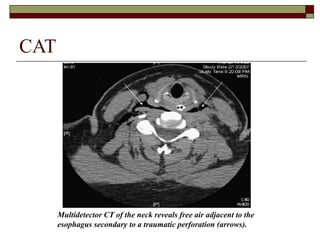 Multidetector CT of the neck reveals free air adjacent to the
esophagus secondary to a traumatic perforation (arrows).
CAT
 