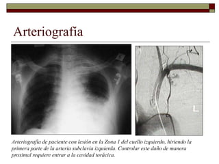 Arteriografía
Arteriografía de paciente con lesión en la Zona 1 del cuello izquierdo, hiriendo la
primera parte de la arteria subclavia izquierda. Controlar este daño de manera
proximal requiere entrar a la cavidad torácica.
 