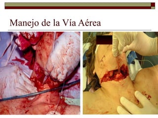 Manejo de la Vía Aérea
 