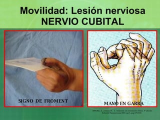 Movilidad: Lesión nerviosa NERVIO CUBITAL SIGNO  DE  FROMENT MANO EN GARRA MOORE, K y DALLEY,  A. Anatomía con orientación...