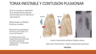 Trauma de-torax | PPTX