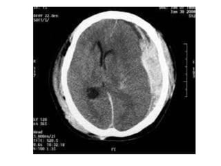 CT Brain
 