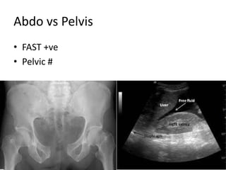 Abdo vs Pelvis
• FAST +ve
• Pelvic #
 