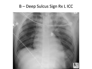 B – Deep Sulcus Sign Rx L ICC
 