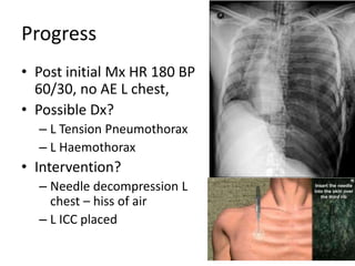 Progress
• Post initial Mx HR 180 BP
60/30, no AE L chest,
• Possible Dx?
– L Tension Pneumothorax
– L Haemothorax
• Intervention?
– Needle decompression L
chest – hiss of air
– L ICC placed
 