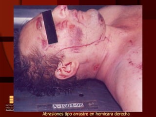 Abrasiones tipo arrastre en hemicara derecha 