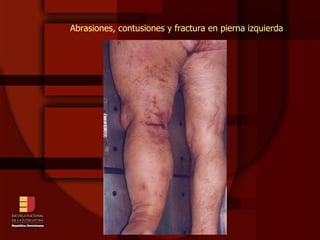 Abrasiones, contusiones y fractura en pierna izquierda 