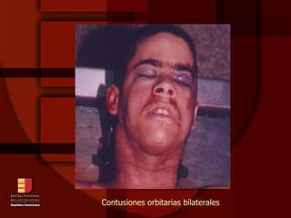 Contusiones orbitarias bilaterales 