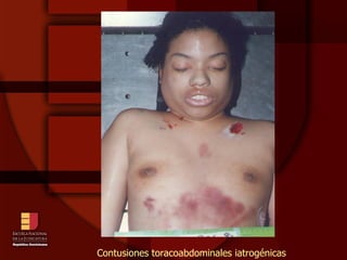 Contusiones toracoabdominales iatrogénicas 