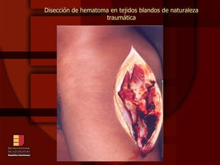 Disección de hematoma en tejidos blandos de naturaleza traumática 