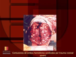 Contusiones de ambos hemisferios cerebrales por trauma craneal severo 