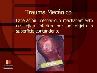 Trauma Mecánico Laceración: desgarro o machacamiento de tejido inferido por un objeto o superficie contundente 