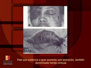 Foto que evidencia a gran aumento una laceración, también denominada herida contusa 