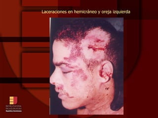 Laceraciones en hemicráneo y oreja izquierda 