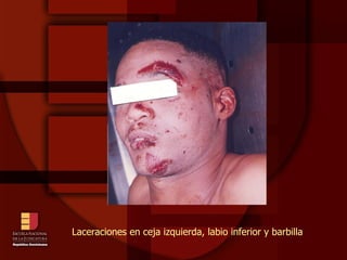 Laceraciones en ceja izquierda, labio inferior y barbilla  