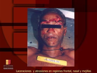Laceraciones  y abrasiones en regiones frontal, nasal y mejillas 