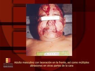 Adulto masculino con laceración en la frente, así como múltiples abrasiones en otras partes de la cara 