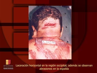 Laceración horizontal en la región occipital; además se observan abrasiones en la espalda 