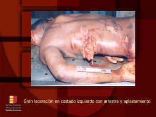 Gran laceración en costado izquierdo con arrastre y aplastamiento 