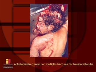 Aplastamiento craneal con múltiples fracturas por trauma vehicular 