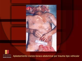 Aplastamiento craneo-toraco-abdominal por trauma tipo vehicular 