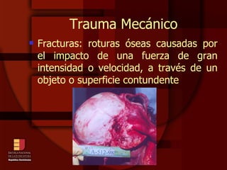 Trauma Mecánico Fracturas: roturas óseas causadas por el impacto de una fuerza de gran intensidad o velocidad, a través de un objeto o superficie contundente 