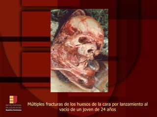 Múltiples fracturas de los huesos de la cara por lanzamiento al vacío de un joven de 24 años 