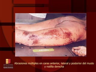 Abrasiones múltiples en caras anterior, lateral y posterior del muslo y rodilla derecha 