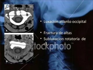 • Luxacion atlanto occipital
• Fractura de altas
• Subluxacion rotatoria de
c1
 